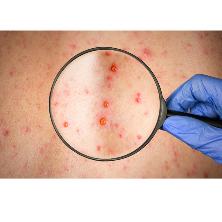 schmerzen von herpes zoster virus, bläschen bildung